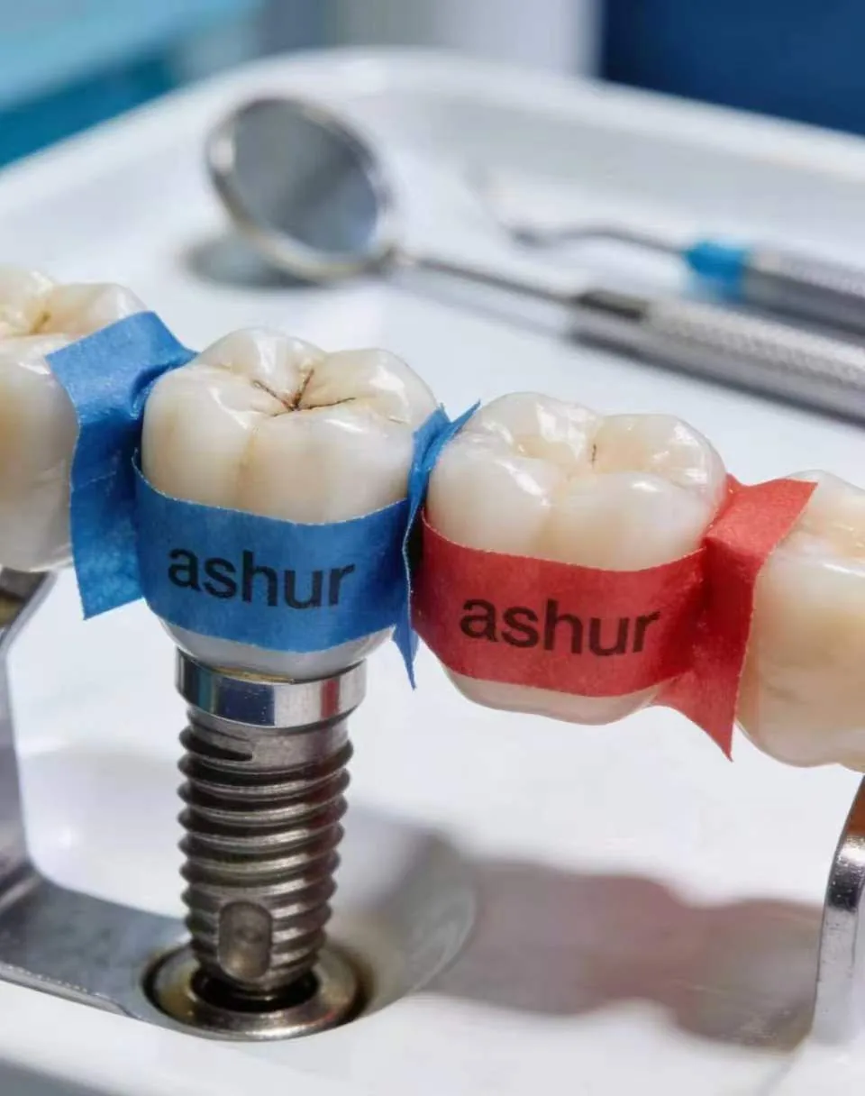 Implant-supported restorations