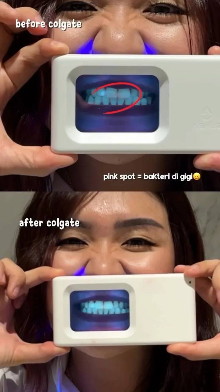 Before-and-after plaque-light viewer comparison, image 27