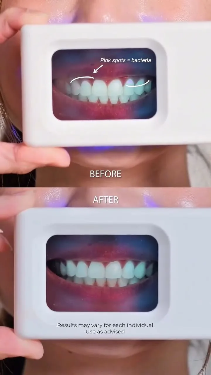 Before-and-after plaque-light viewer comparison, image 41