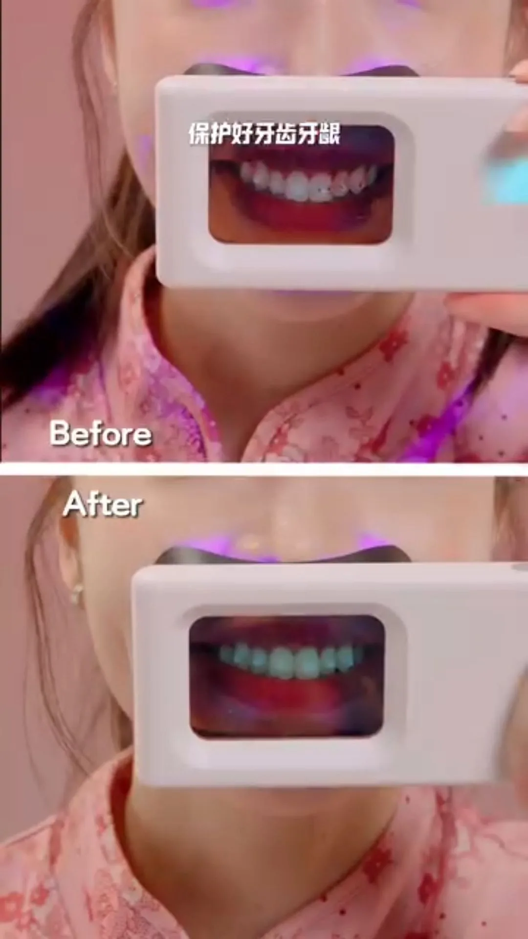 Before-and-after plaque-light viewer comparison, image 43