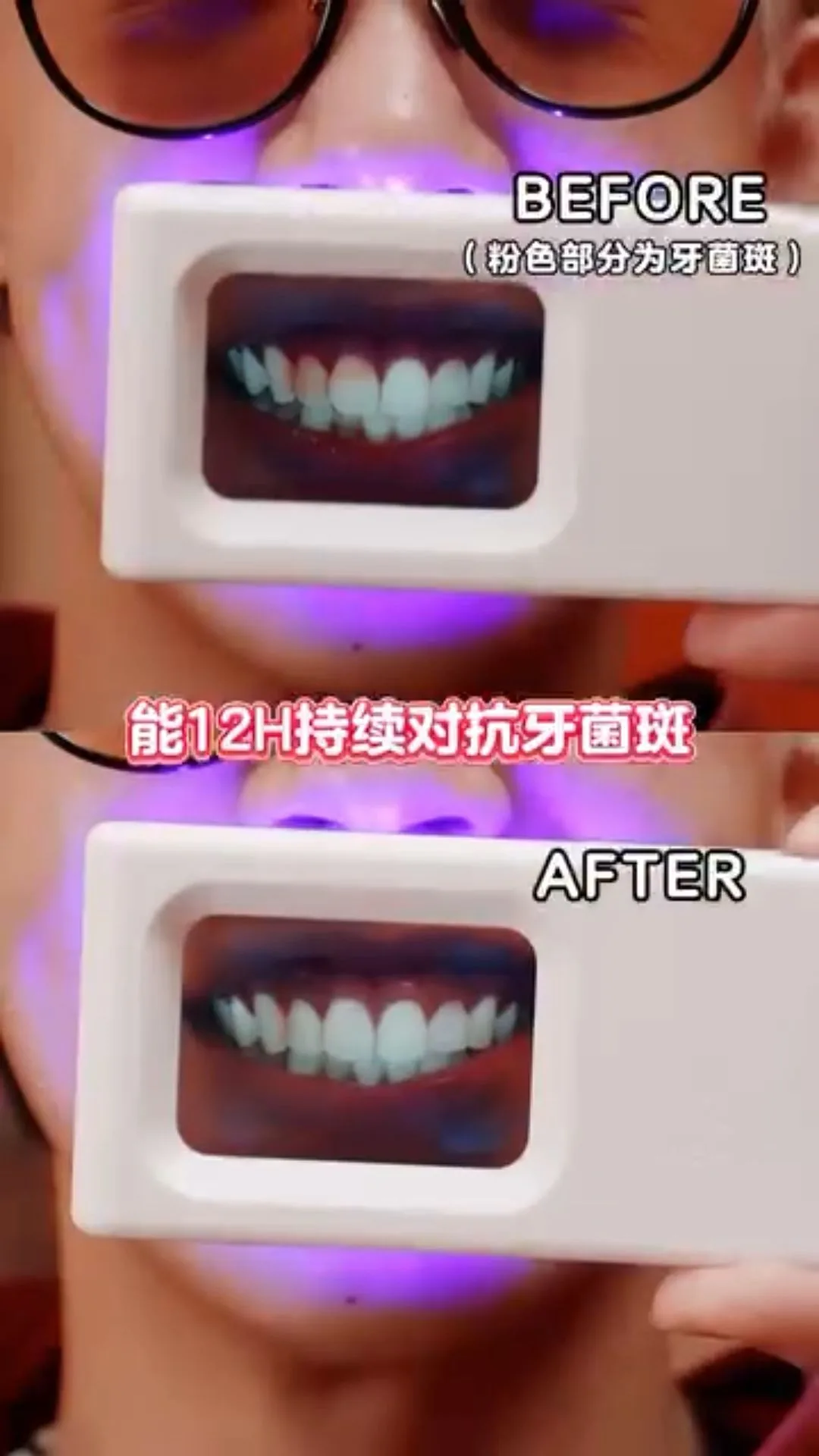 Before-and-after plaque-light viewer comparison, image 45